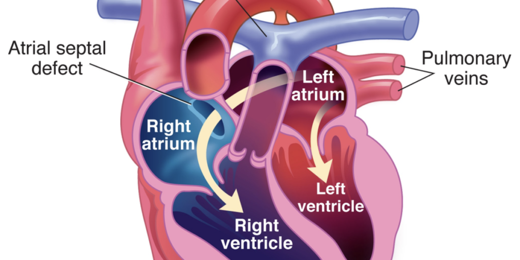 Atrial septal defect.