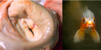 Mitral Stenosis