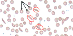 Sickle Cell Anemia