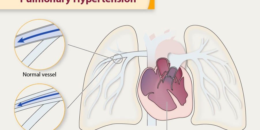 Pulmonary Hypertension