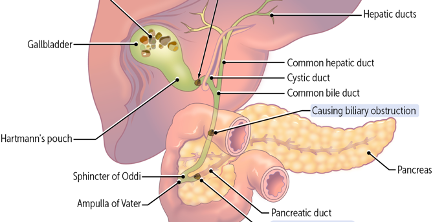 Cholelithiasis and Cholecystitis