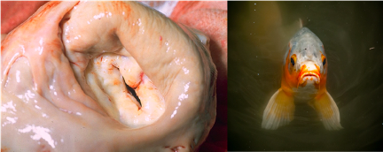 Mitral Stenosis