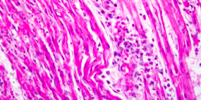 Myocarditis
