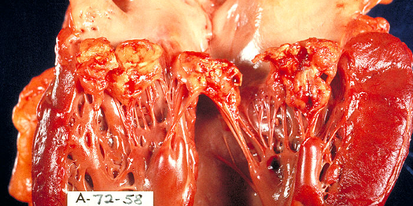 Infective endocarditis