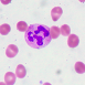 Megaloblastic Anemia
