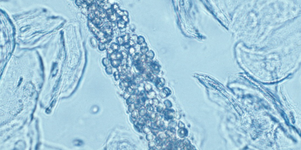 nephritic syndrome