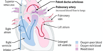 Patent Ductus Arteriosus