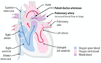 Patent Ductus Arteriosus