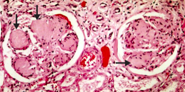 Diabetic Nephropathy
