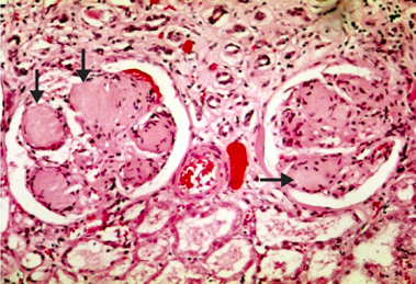 Diabetic Nephropathy
