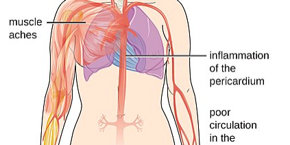 systematic lupus erythematosus